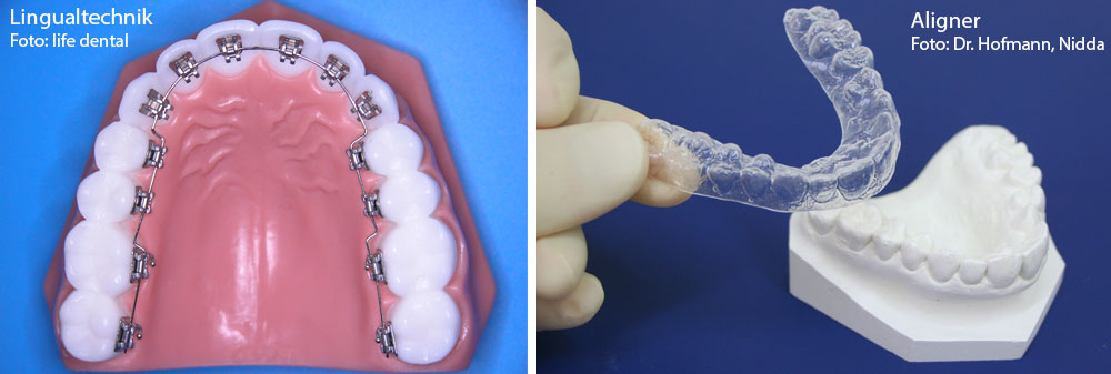 Kieferorthopädische Praxis in Nidda, Dr. Jörg Hofmann, Spezialist für Kiefer-Korrekturmöglichkeiten durch eine unsichtbare feste Zahnspangen. Durch Aliner (zweites Bild) können Zähne fast unsichtbar korrigiert werden.